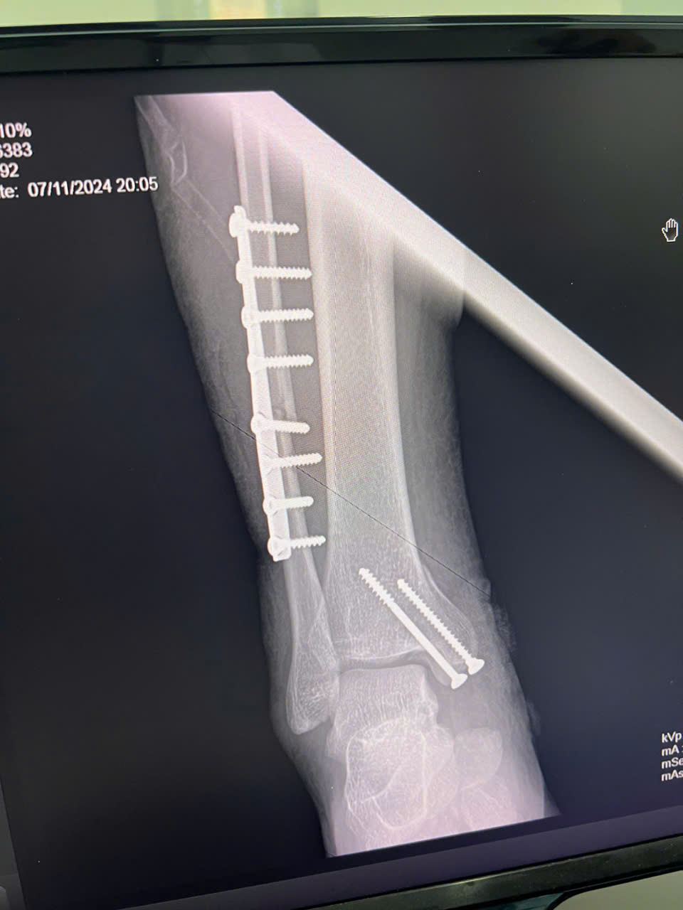 Trung tâm y tế huyện Tiên Du thực hiện thành công ca phẫu thuật kết hợp xương